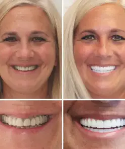 DentureGlow™ –🦷Get a Perfect Smile Fast!🦷 (⏰30-Min Flash Sale Ends Soon!⏰)