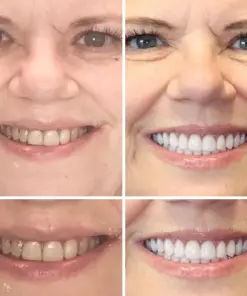 DentureGlow™ –🦷Get a Perfect Smile Fast!🦷 (⏰30-Min Flash Sale Ends Soon!⏰)