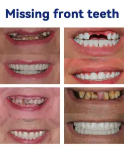 GripNFit™ Silicone Denture Set