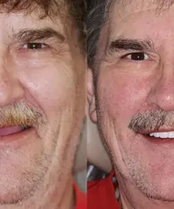 HZA™ Advanced Customized Full Denture Set