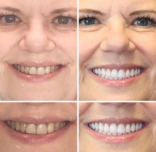HZA™ Advanced Customized Full Denture Set