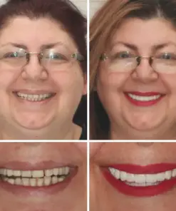 HZA™ Advanced Customized Full Denture Set