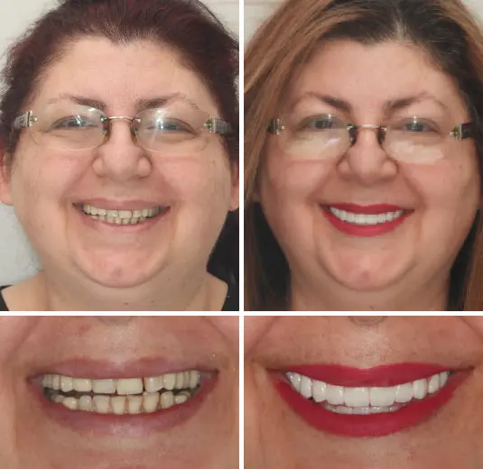 HZA™ Advanced Customized Full Denture Set
