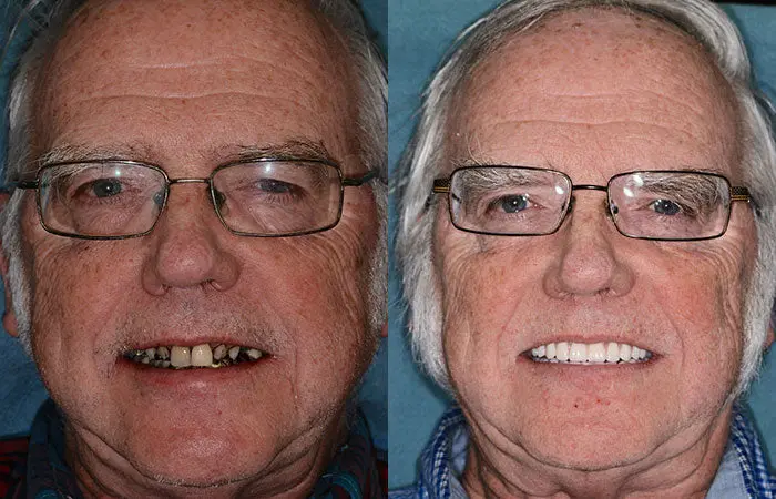 HZA™ Advanced Customized Full Denture Set