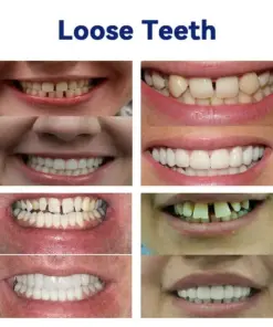 NESLEMY®-🦷Advanced Customized Full Denture Set