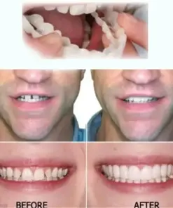 Nurbini™ Adjustable Snap Prosthesis