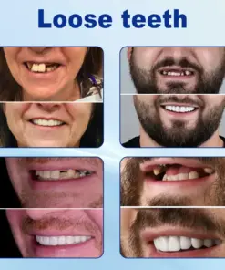 Nurbini® Advanced Customized Full Denture Set
