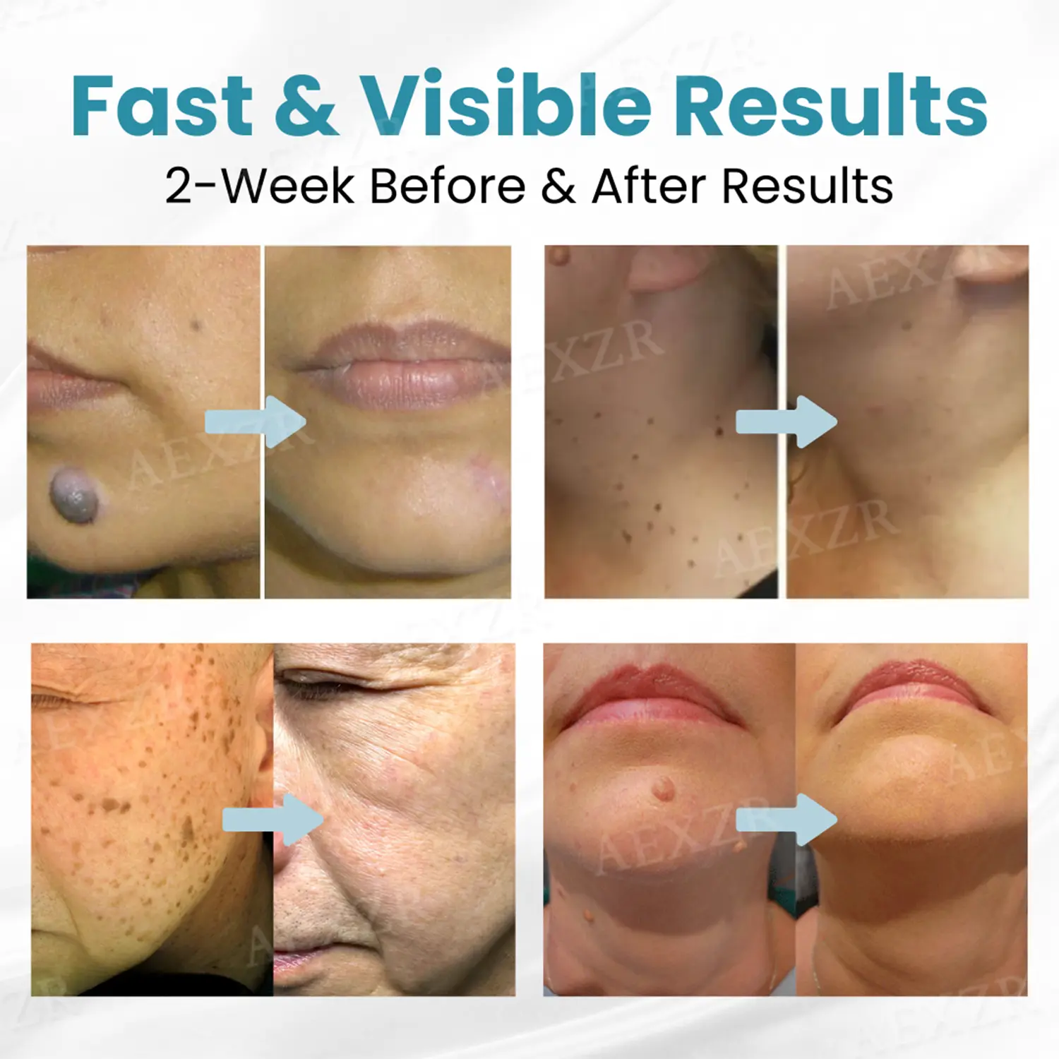 Nurbini® Non-invasive Mole and Wart Removal Laser Pen