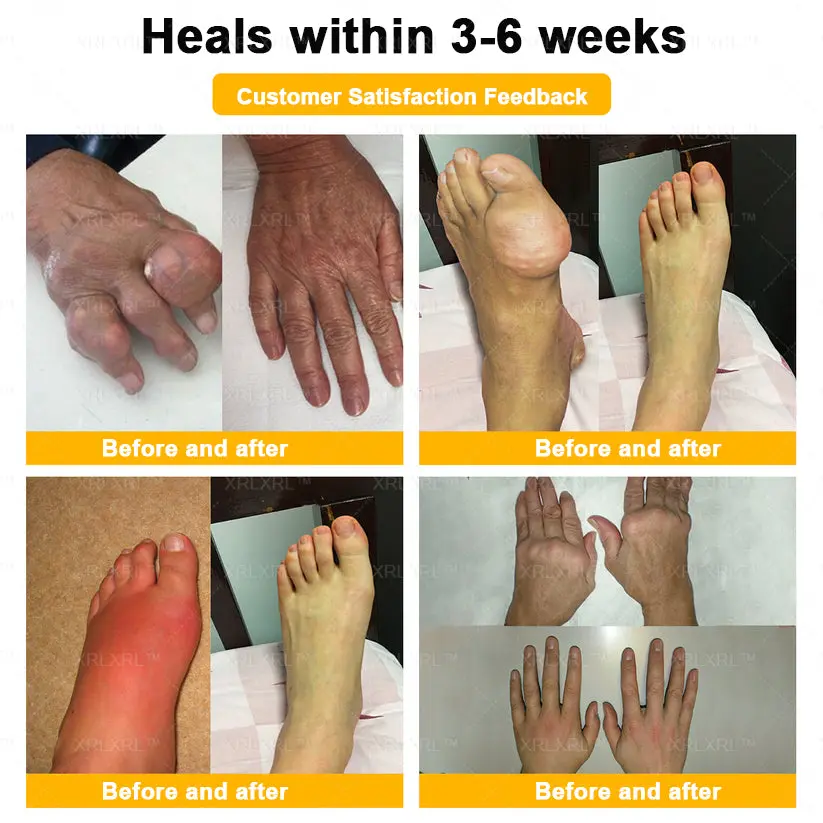 XRLXRL™ Bee Venom Pain-Relief Bone Healing Cream