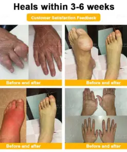 ZVLZVL® Bee Venom Pain-Relief Bone Healing Cream