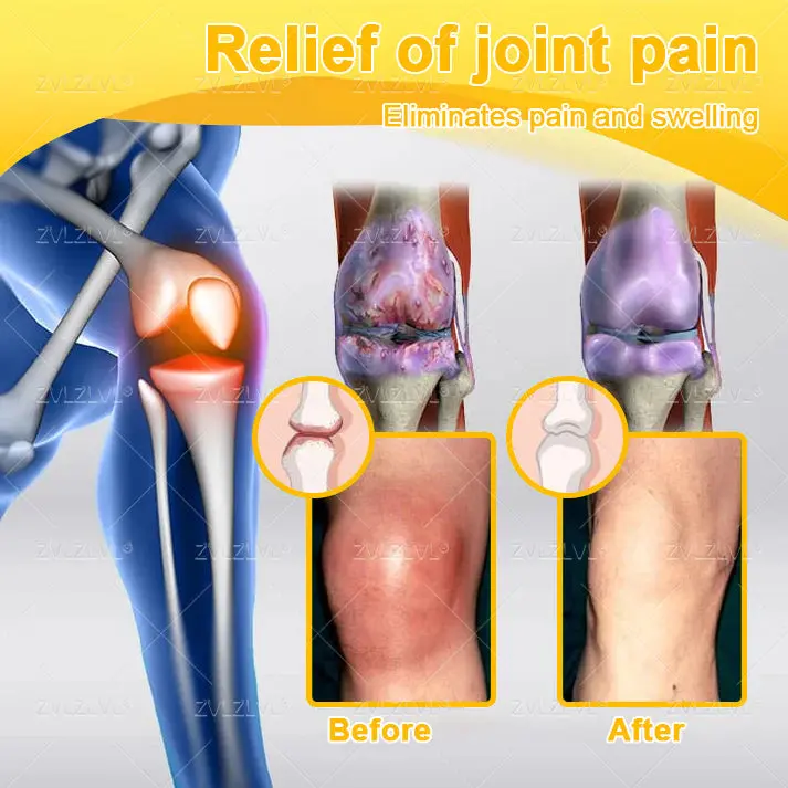 ZVLZVL® Bee Venom Pain-Relief Bone Healing Cream