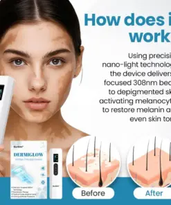 Nurbini® DermaBeam Vitiligo Therapy device