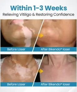 Nurbini® DermaBeam Vitiligo Therapy device