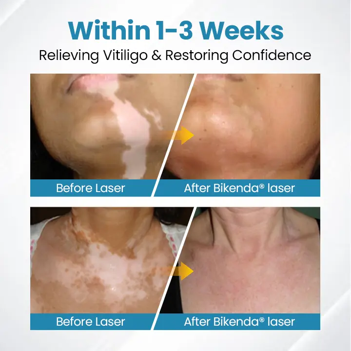 Nurbini® DermaBeam Vitiligo Therapy device