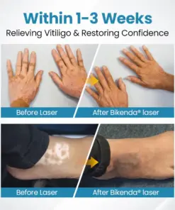 Nurbini® DermaBeam Vitiligo Therapy device