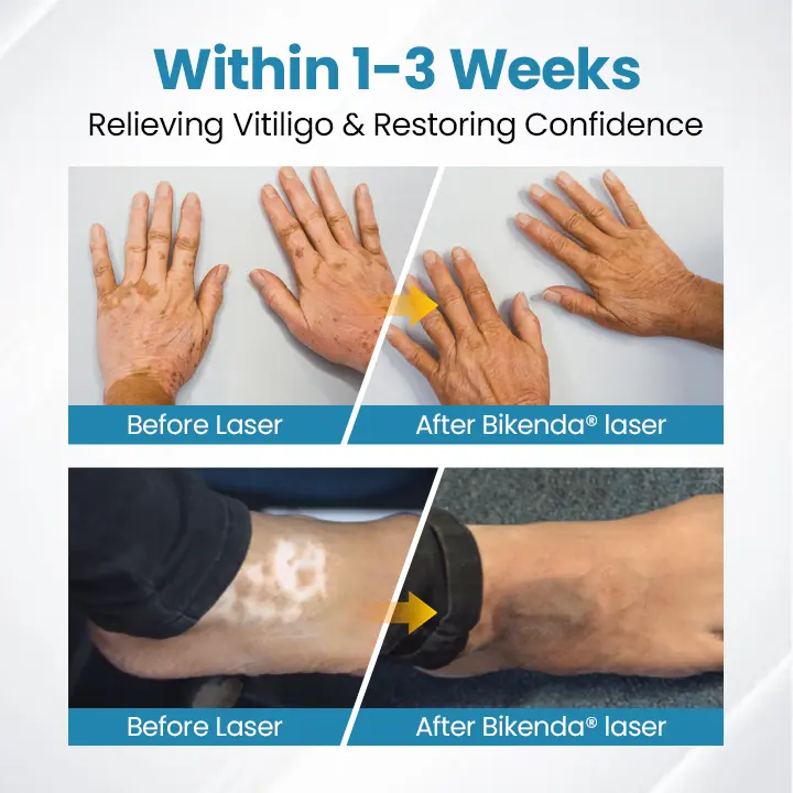 Nurbini® DermaBeam Vitiligo Therapy device